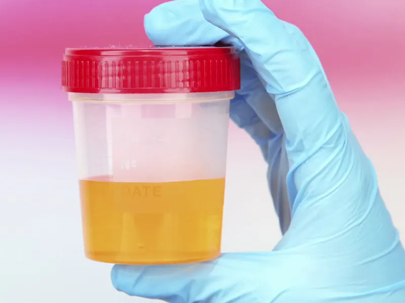 Comprehensive Urinalysis Evaluation (CUE)